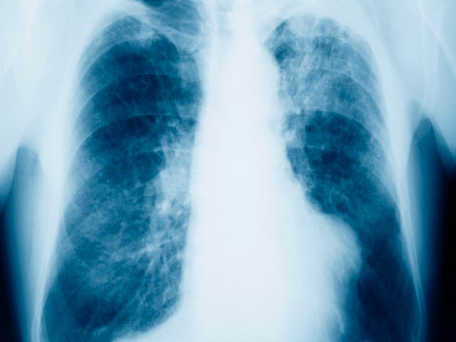 <p>A new treatment for lung cancer is being trialled at The Royal Brompton Hospital </p>